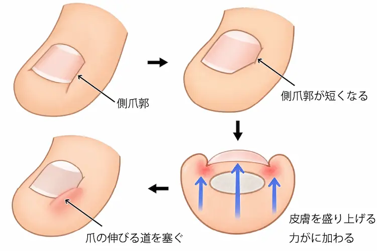 深爪が痛くなる理由を説明したイラスト