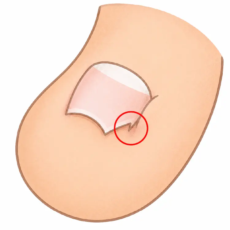 爪の根元にトゲが残っている様子