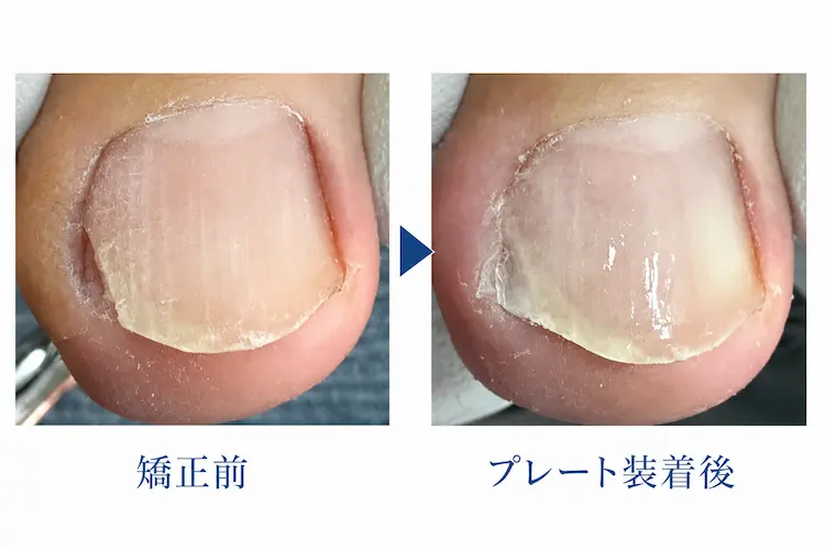 矯正前の写真と深爪矯正用のプレートを装着した後の様