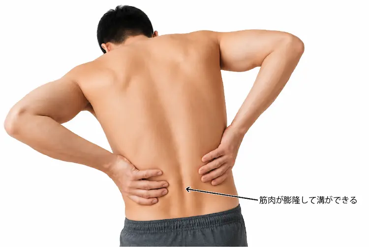 筋・筋膜性腰痛の症状２