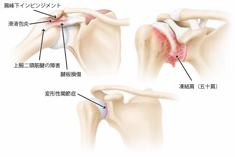 肩鎖関節症に似た疾患