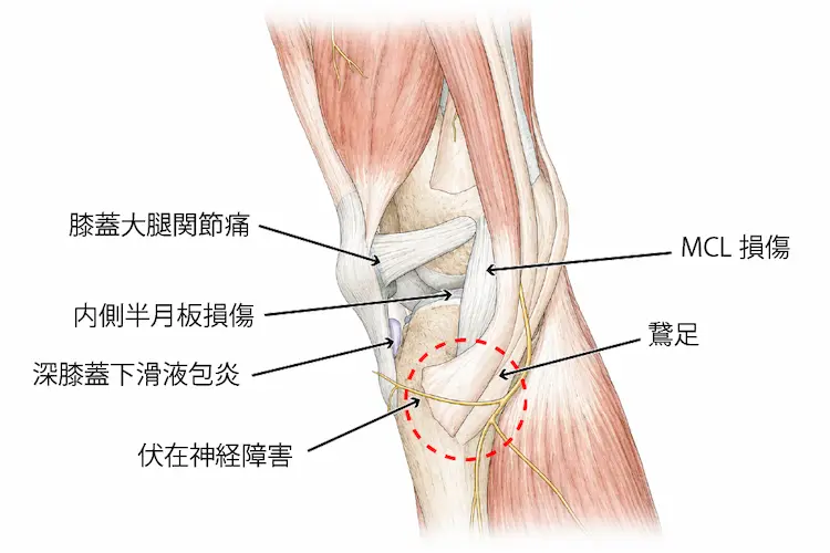 鵞足炎に似た疾患を図示したイラスト