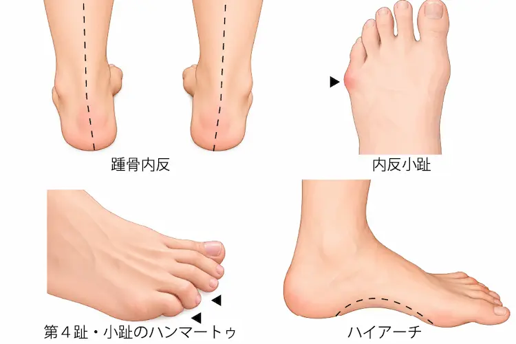 踵骨内反、内反小趾、第４趾・小趾のハンマートゥ、ハイアーチ