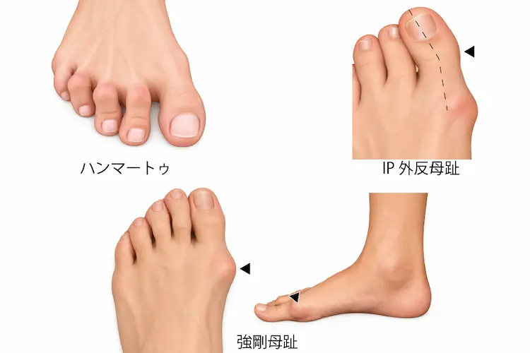 ハンマートゥ、IP外反母趾、強剛母趾のイラスト