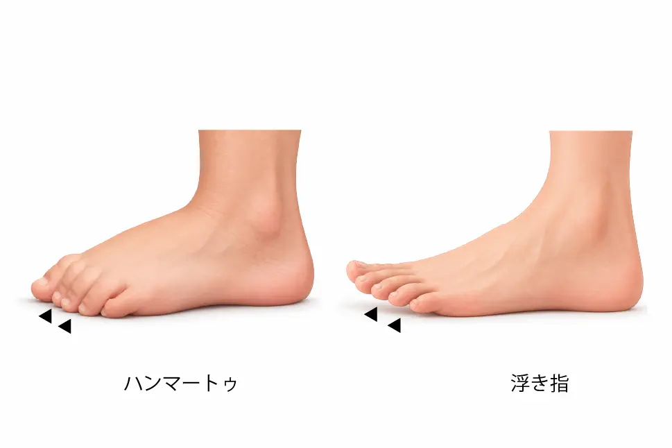 タイプ④ 筋力不足タイプの特徴