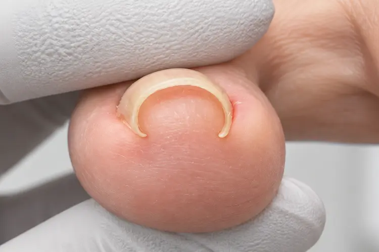 トランペット状に巻いた爪の写真