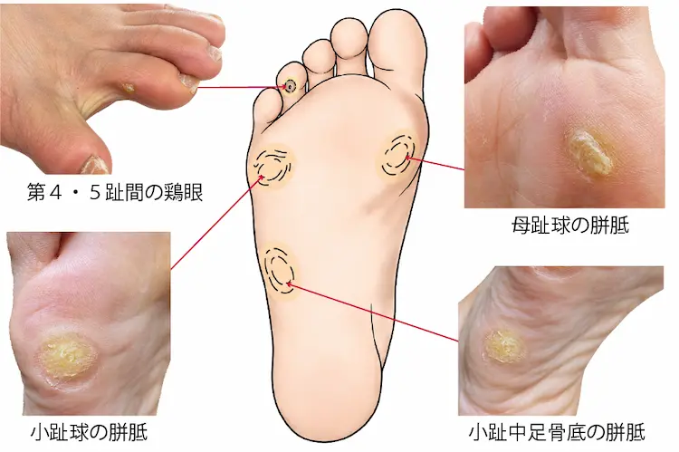 母趾球の胼胝、小趾球の胼胝、小趾中足骨底の胼胝、第4・5趾間の鶏眼のイラスト