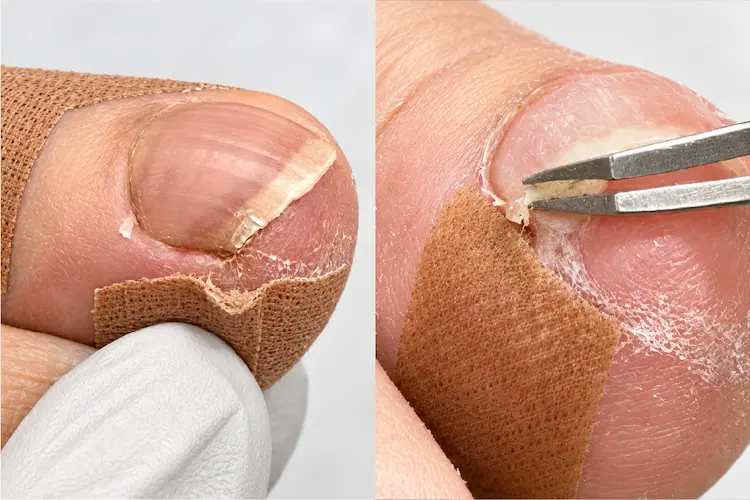 巻き爪の痛いところに爪のトゲがある様子