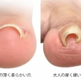 子供の巻き爪｜原因・症状・治し方と正しい爪の切り方