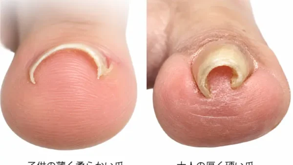 子供の巻き爪|原因・症状・治し方と正しい爪の切り方