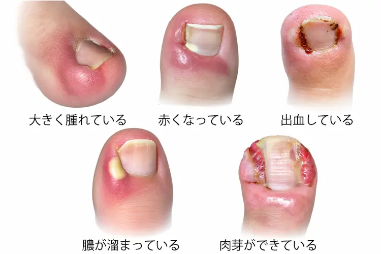爪の横が真っ赤になっている様子の写真大きく腫れている様子の写真出血している様子の写真膿が出ている様子の写真肉芽ができている様子の写真