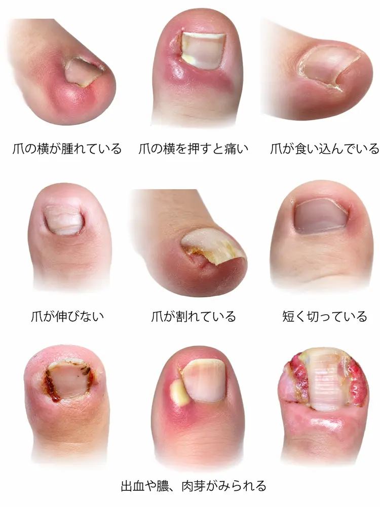 爪の横が赤く腫れている様子の写真 爪の横を押すと痛がる様子の写真 爪を極端に短く切っている様子の写真 爪の端が皮膚に食い込んでいる様子の写真 爪が割れている様子の写真 爪がなかなか伸びてこない様子の写真 出血や膿、肉芽がみられる様子の写真