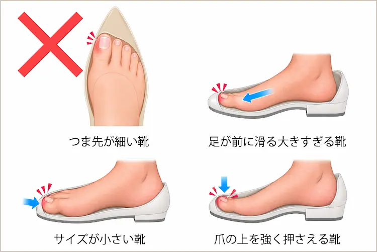 つま先が細い靴、サイズが小さい靴、足が前に滑る大きすぎる靴、爪の上を強く押さえる靴のイラスト