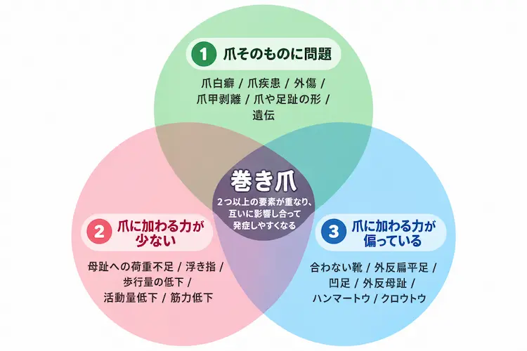 巻き爪の原因を説明したイラスト