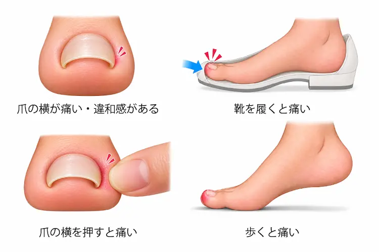 爪の横が痛い爪の横を押すと痛い靴を履くと痛い歩くと痛い爪の端に違和感がある様子のイラスト