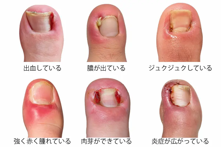 出血している膿が出ている強く赤く腫れているジュクジュクしている肉芽ができている炎症が広がっている様子を表した写真