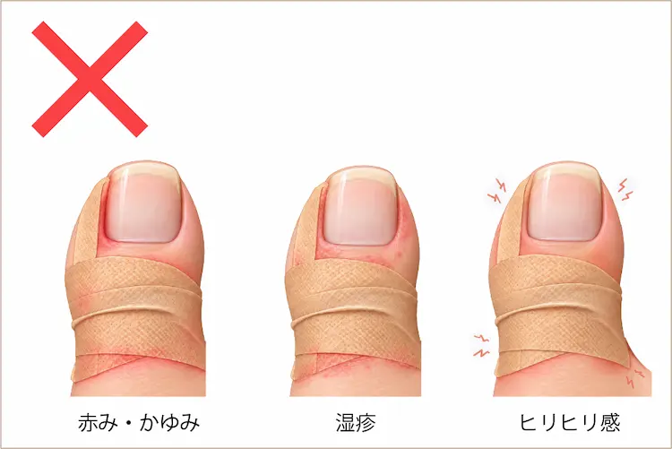 赤み、かゆみ、湿疹、ヒリヒリ感が出た様子のイラスト