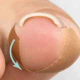 巻き爪テーピングの方法と限界｜自分でできる応急処置