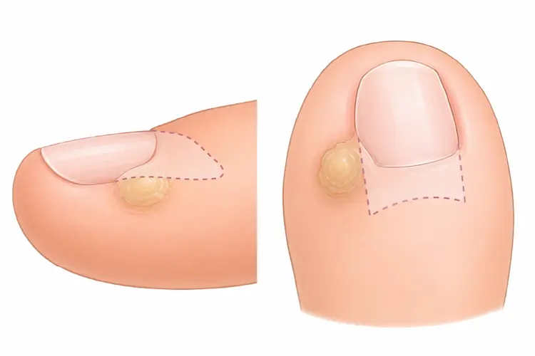 広義の副爪の根元部分を説明をしたイラスト