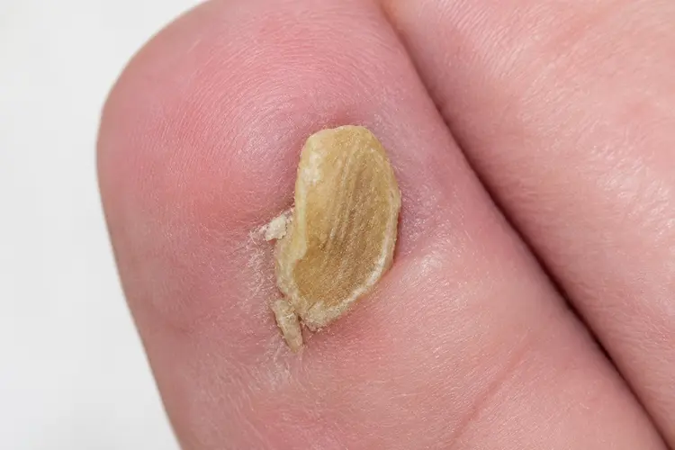 爪が剥がれた後に爪が厚くなった様子の写真