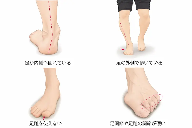 足が内側へ大きく倒れている人足の外側ばかりで歩いている人足趾をほとんど使っていない人足関節や足趾の関節が硬い人のイラスト