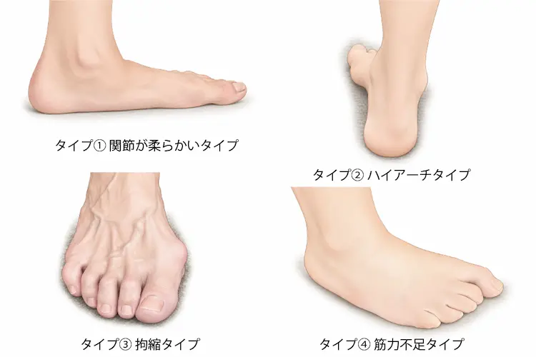 歩き方と巻き爪の関係２