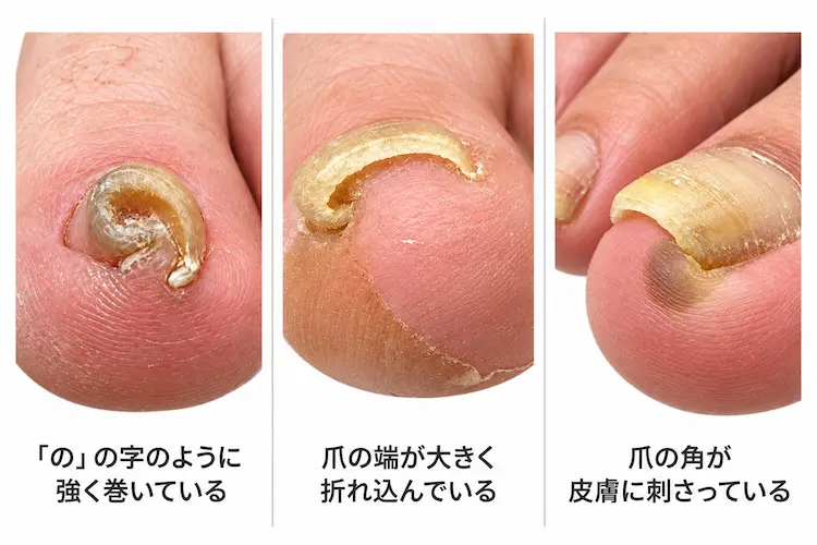 歩き方を治すだけではなく爪への対応が必要な例