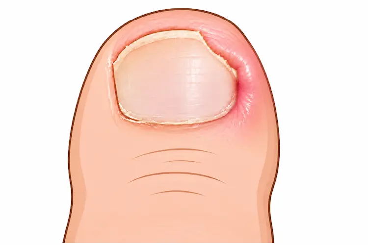 爪の棘が皮膚の下に潜り傷つける様子のイラスト
