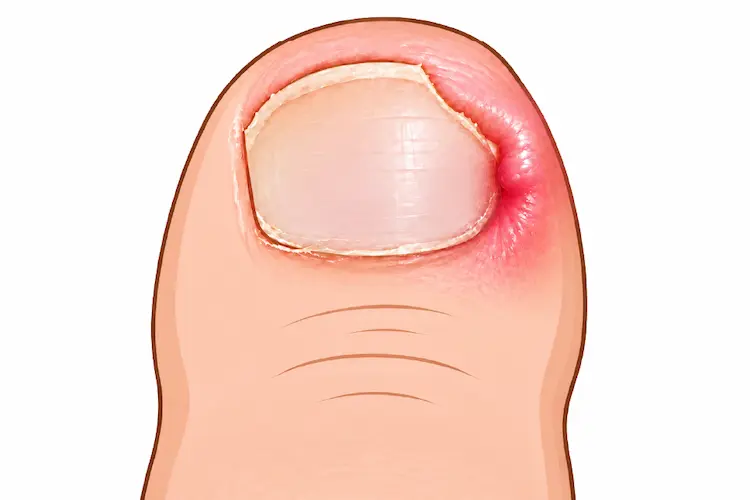 爪のサイドが赤く腫れている様子のイラスト