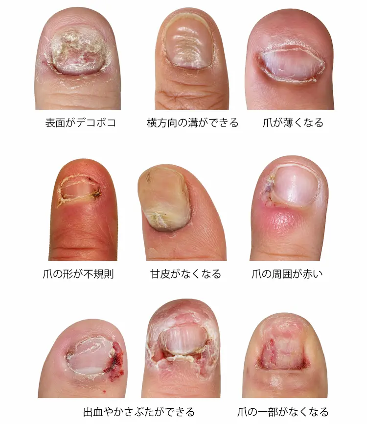爪の表面がデコボコする横方向の溝が何本もできる爪が薄くなる爪の形が不規則になる甘皮がなくなる爪の周囲が赤くなる出血やかさぶたができる爪の一部がなくなる