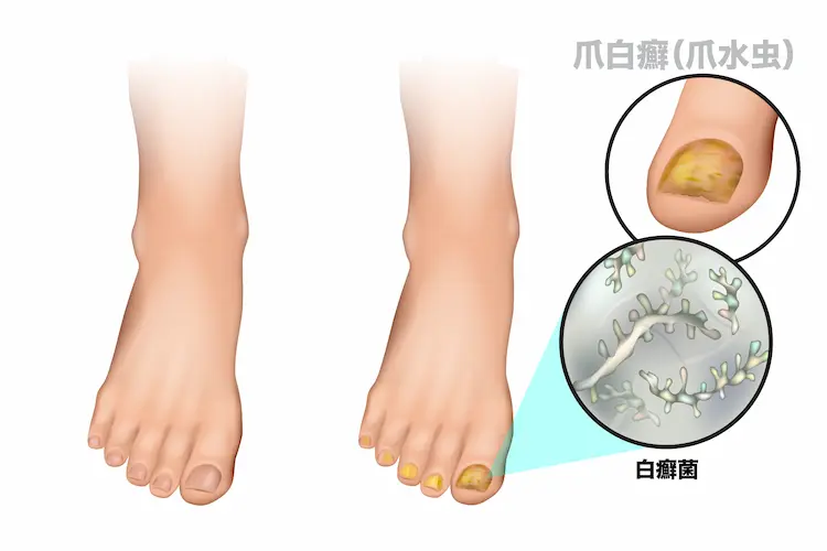 爪水虫のメカニズムを図示したイラスト