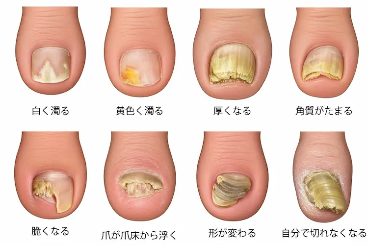 爪水虫の症状を８つイラスト化してある