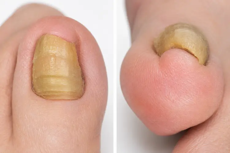 爪が厚く硬くなった様子を上からと前方から撮った写真