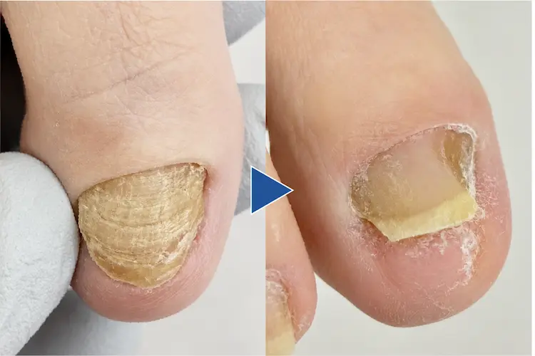 肥厚した爪を薄く削って綺麗にした写真
