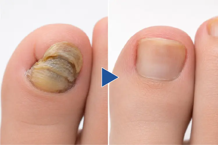 肥厚した爪を薄く削って綺麗にした写真