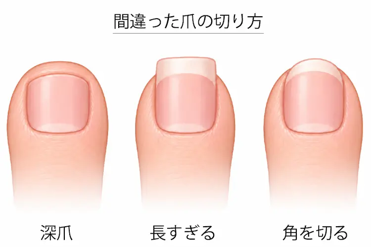 爪を短く切りすぎたイラスト 爪が長すぎるイラスト 爪の角を切りすぎているイラスト