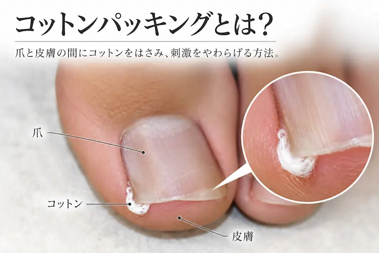 コットンパッキングによる巻き爪ケア