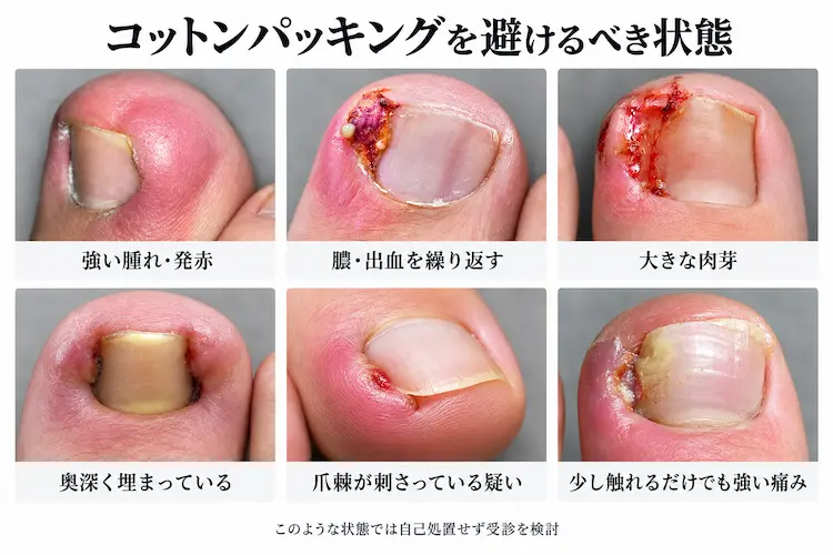 コットンパッキングを避けるべき状態