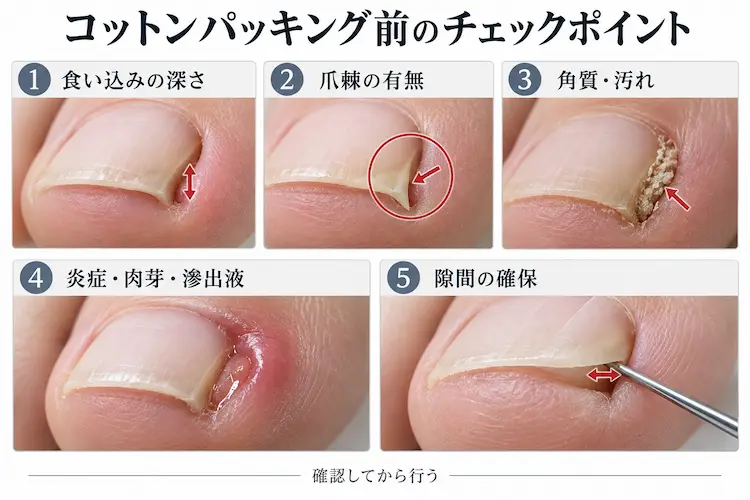コットンパッキング前の爪チェックポイント