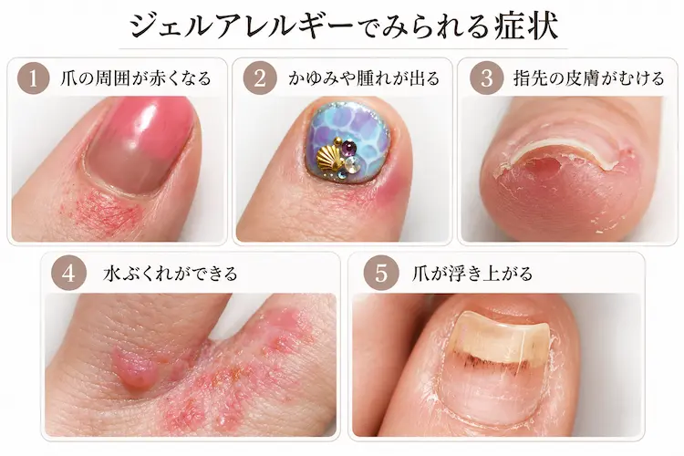 ジェルアレルギーの症状一覧