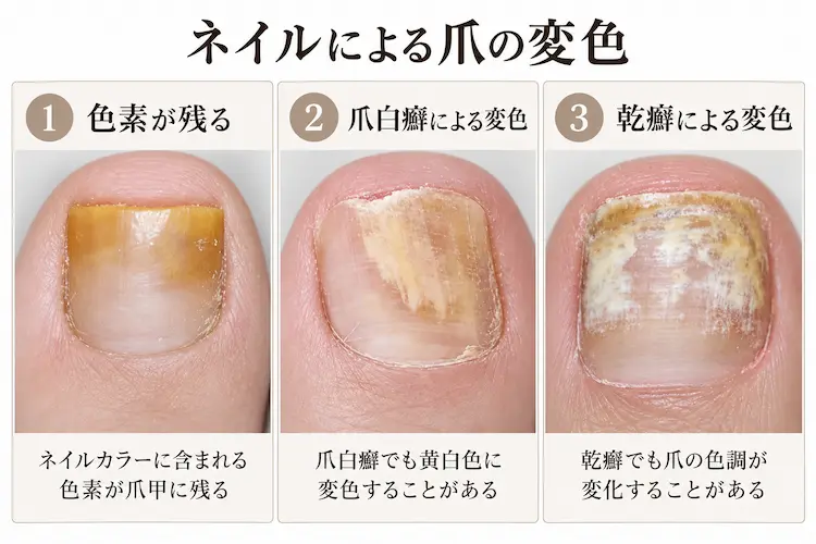 ネイルによる爪の変色ガイド