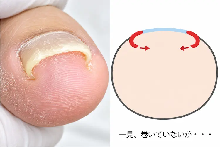 ホッチキス型の巻き爪が痛い理由を説明したイラスト