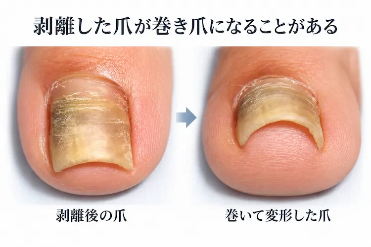 剥離した爪から巻き爪への変化