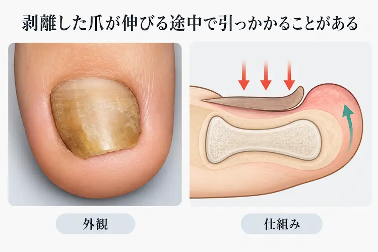 剥離した爪が引っかかる仕組み