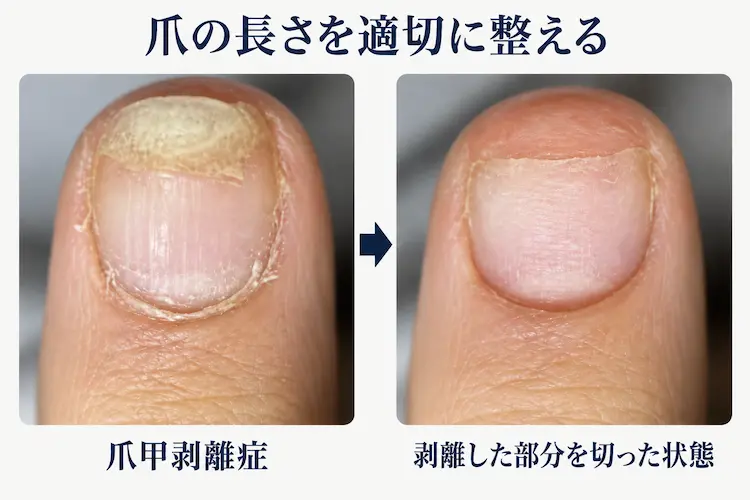 剥離した爪の長さを整える