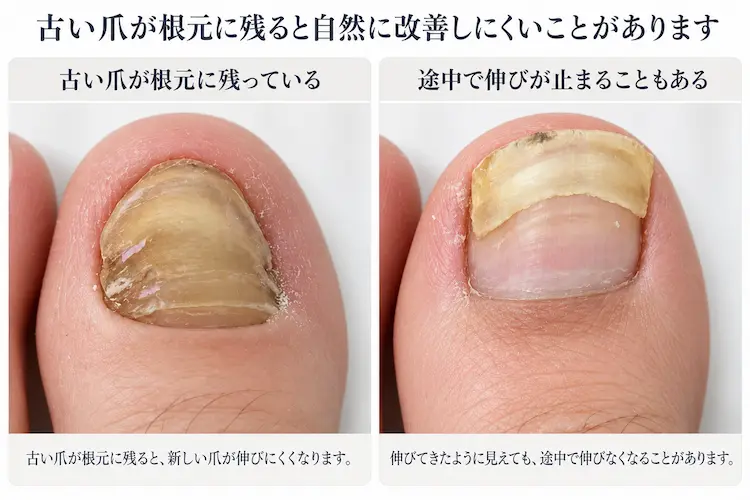 古い爪が残る足爪ケア図解