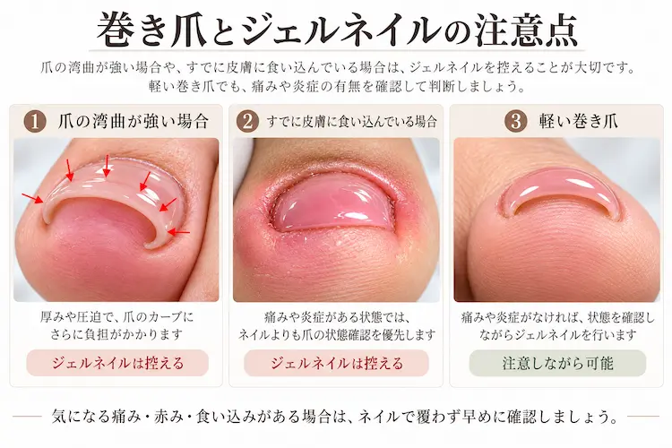 巻き爪とジェルネイルの注意点 infographics
