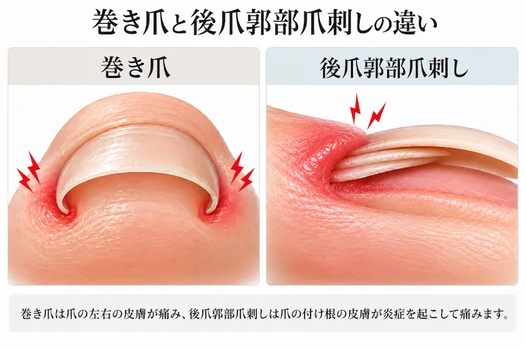 巻き爪と後爪郭部爪刺しの違い