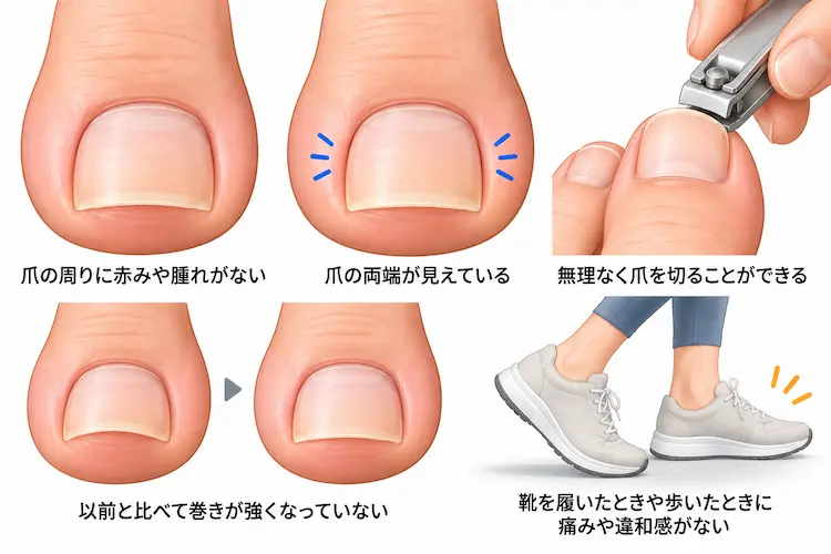 爪の周りに赤みや腫れがない爪の両端が見えている無理なく爪を切ることができる以前と比べて巻きが強くなっていない靴を履いたときや歩いたときに痛みや違和感がない