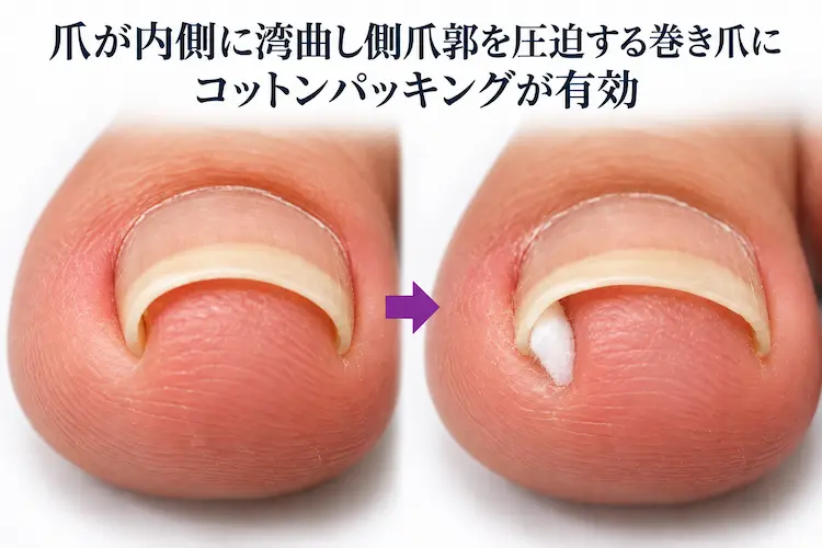 巻き爪へのコットンパッキング効果